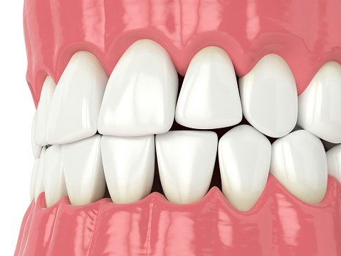คอมโพสิตวีเนียร์ (Composite Veneer)