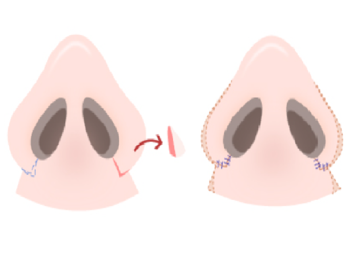 การตัดเนื้อออกเพื่อลดความกว้างของฐานจมูก