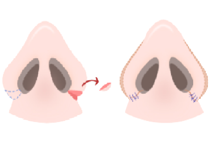 การตัดเนื้อจมูกด้านข้างหรือการตัดความหนาของปีกจมูก