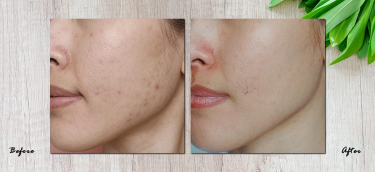 7 ตัวช่วยรักษารอยสิวยอดนิยม เห็นผลจริง โดย KOII KOII - Beauty Diary