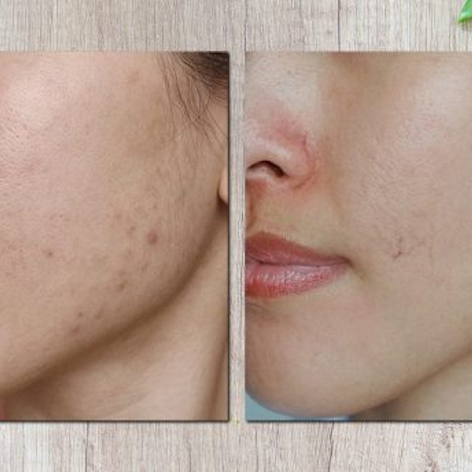 7 ตัวช่วยรักษารอยสิวยอดนิยม เห็นผลจริง โดย KOII KOII - Beauty Diary