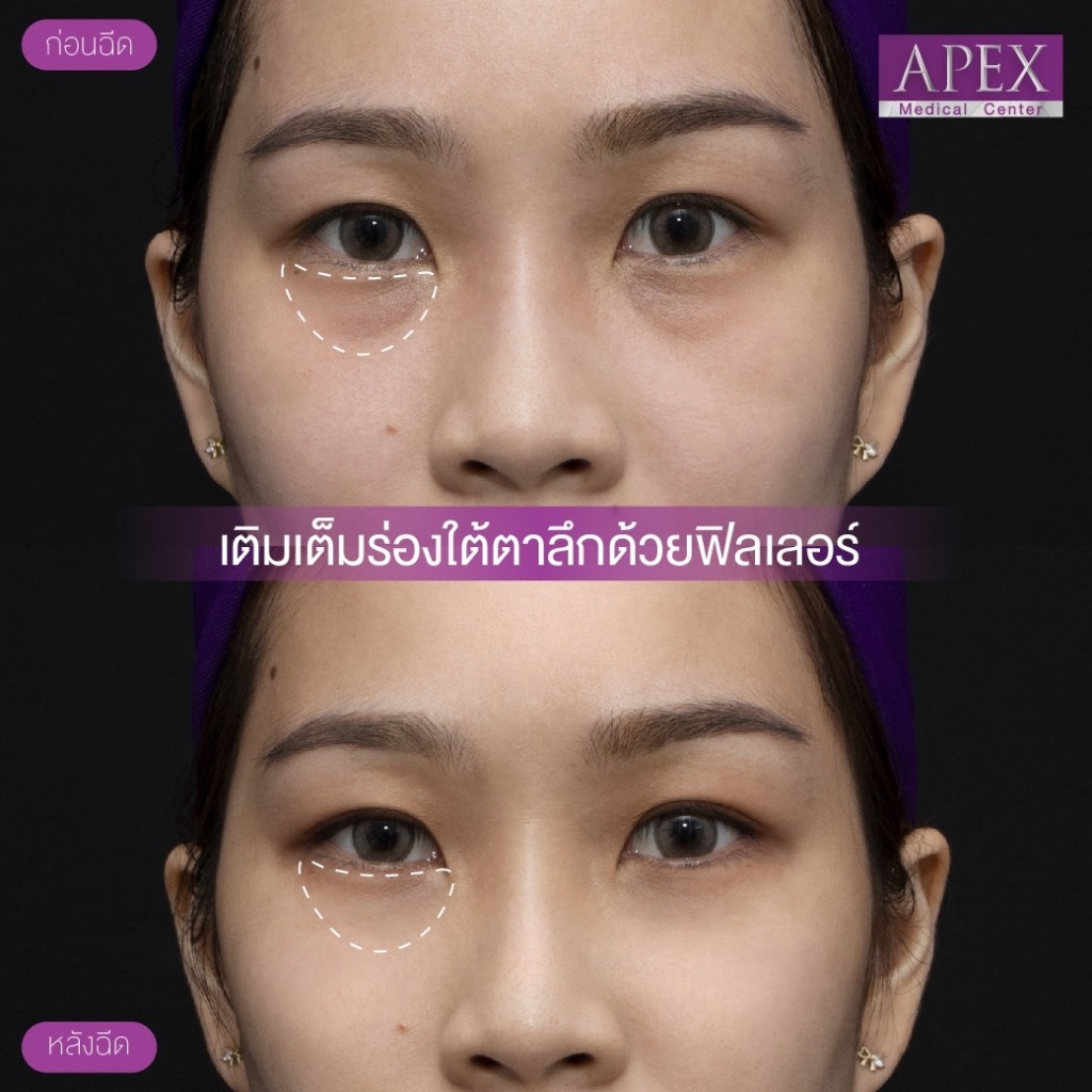 โปรแกรมฉีดฟิลเลอร์ Restylane 3