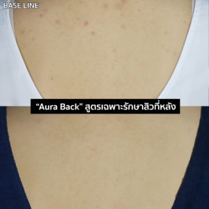โปรแกรมรักษาสิวที่หลัง 3