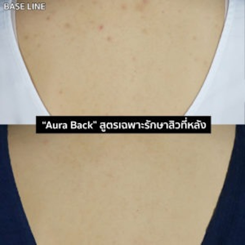 โปรแกรมรักษาสิวที่หลัง 3