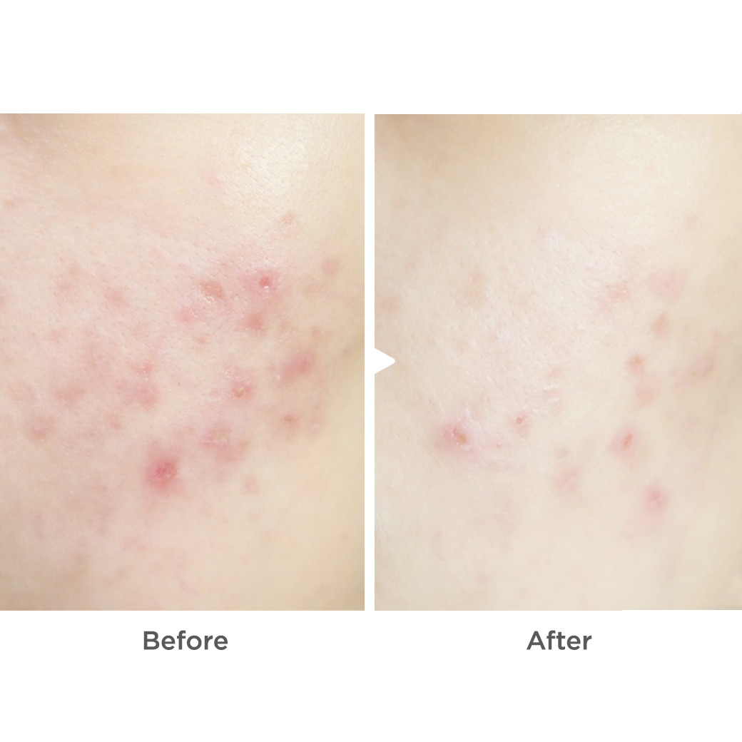 สกินแคร์ในวัตสัน V Acne Clear Booster 3