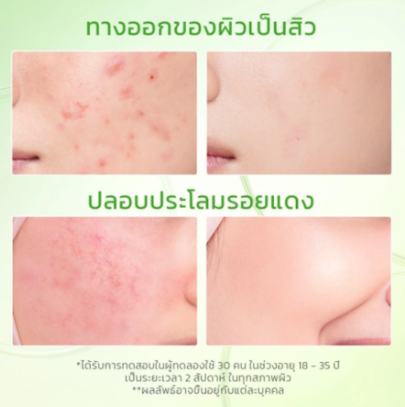Kiwi 3D Acid Acne Moisturizer 3