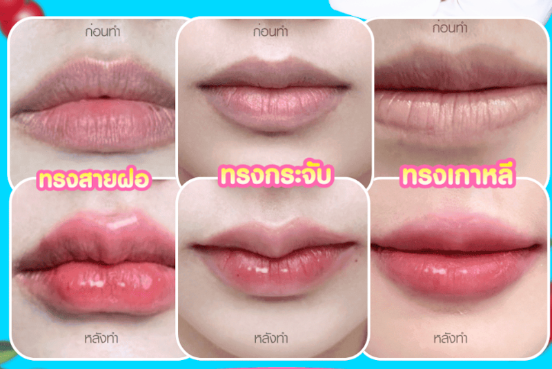 ฉีดฟิลเลอร์ปากกระจับ ปากสายฝอ 3