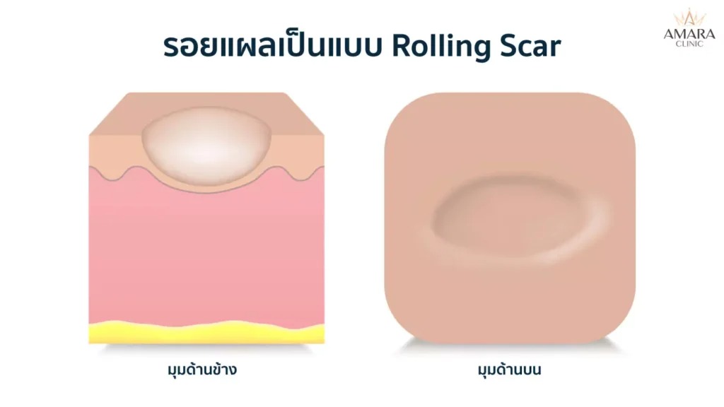 โปรแกรมรักษาสิวที่หลัง 2