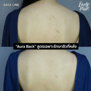 โปรแกรมรักษาสิวที่หลัง 2