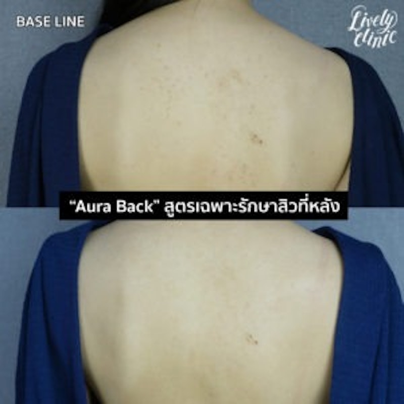 โปรแกรมรักษาสิวที่หลัง 2
