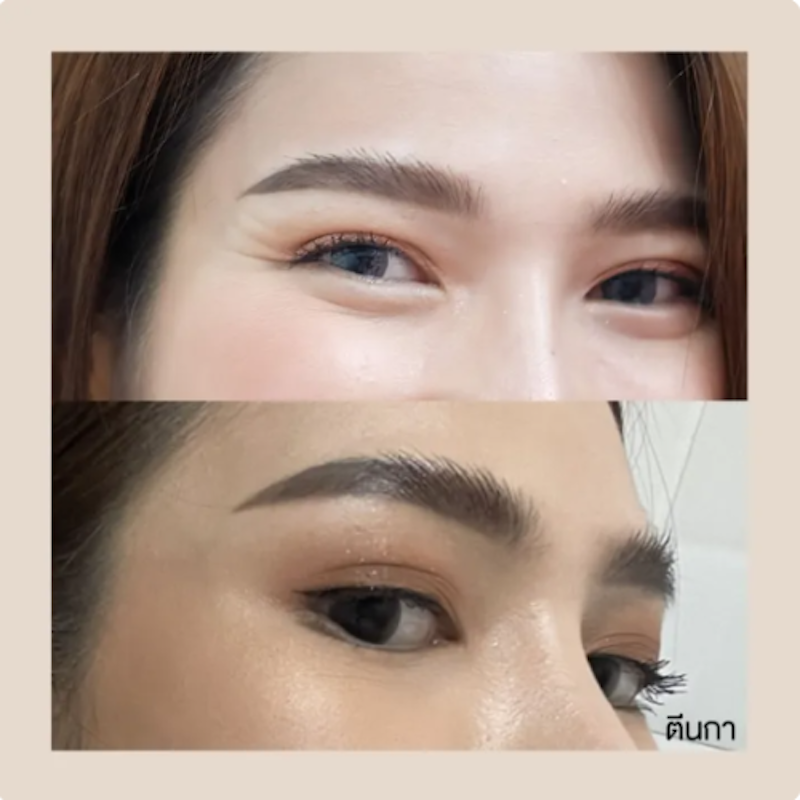 Botox (Aestox) โบท็อกซ์ ริ้วรอย 3