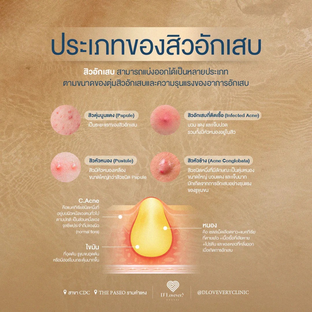 โปรแกรมรักษาสิวที่หลัง 3
