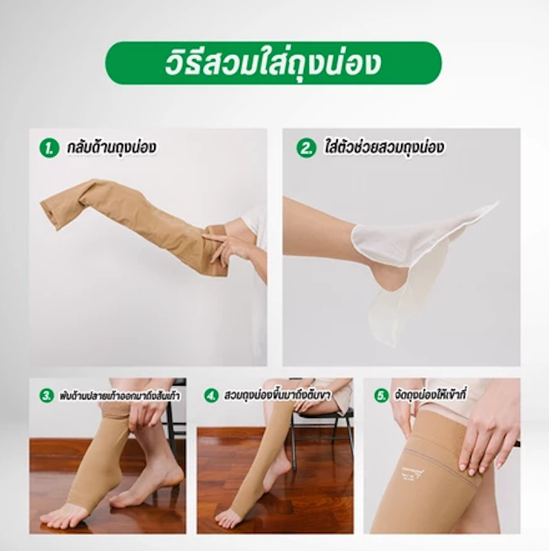 ถุงน่องเส้นเลือดขอด ระดับ 1 2