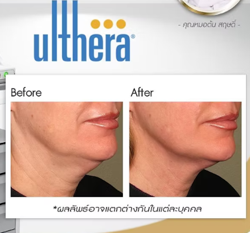 โปรแกรมทำ Ulthera 2