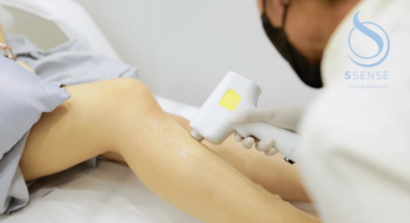 เลเซอร์กำจัดขนใต้วงแขนด้วยเครื่อง Diode Laser 1 ปี/12 ครั้ง 3