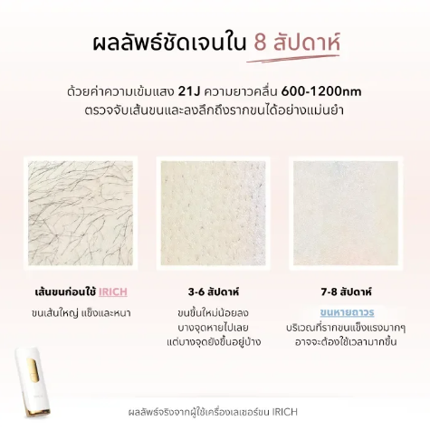เครื่องเลเซอร์ขน 4
