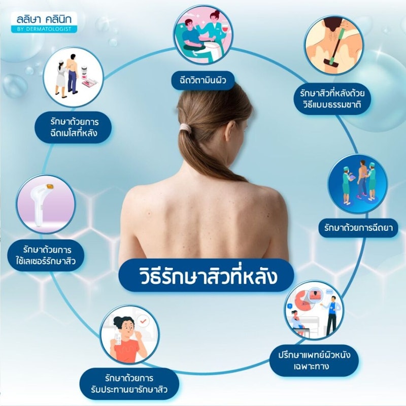 โปรแกรมรักษาสิวที่หลัง 2