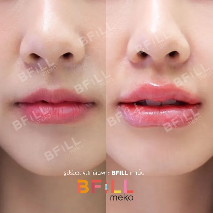 Filler Korea Juvederm Voluma 2