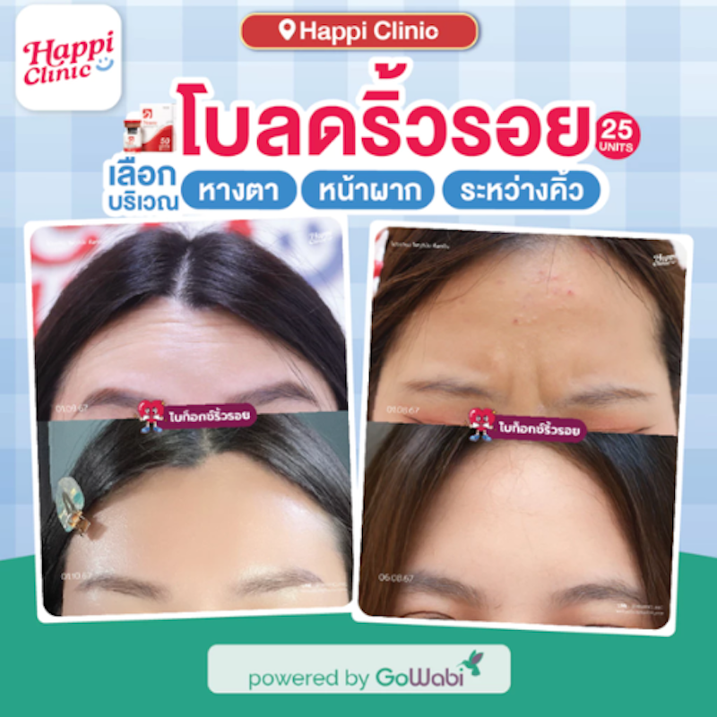 ฉีดโบท็อกซ์ Neuronox 2
