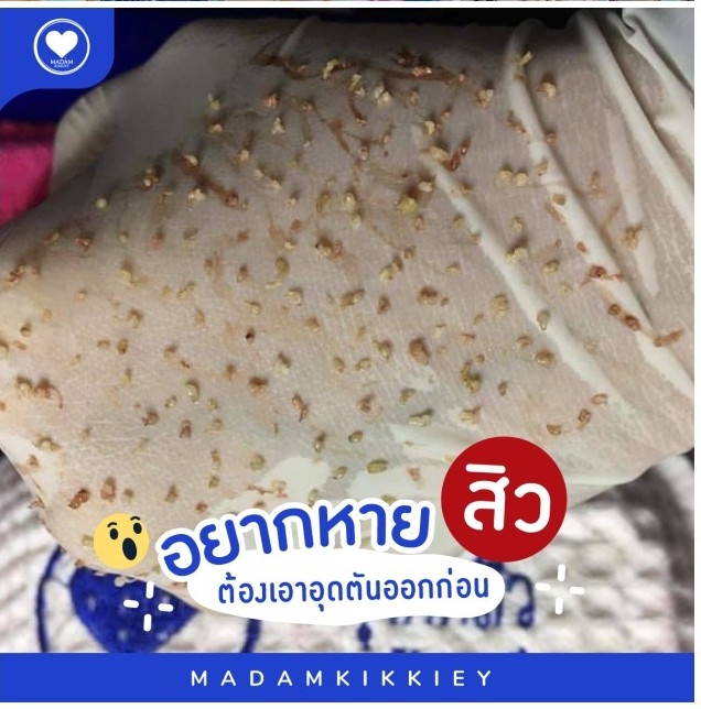 พี่กุ้งกดสิว คลินิกกดสิว 2