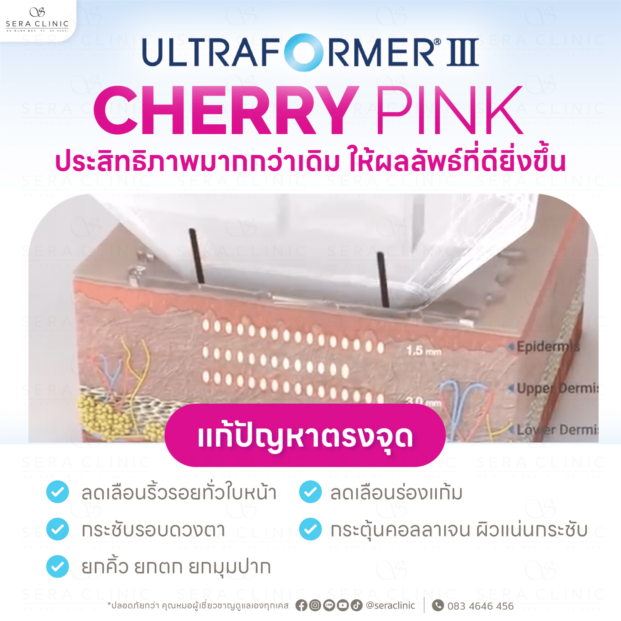 โปรแกรมทำ Hifu 3
