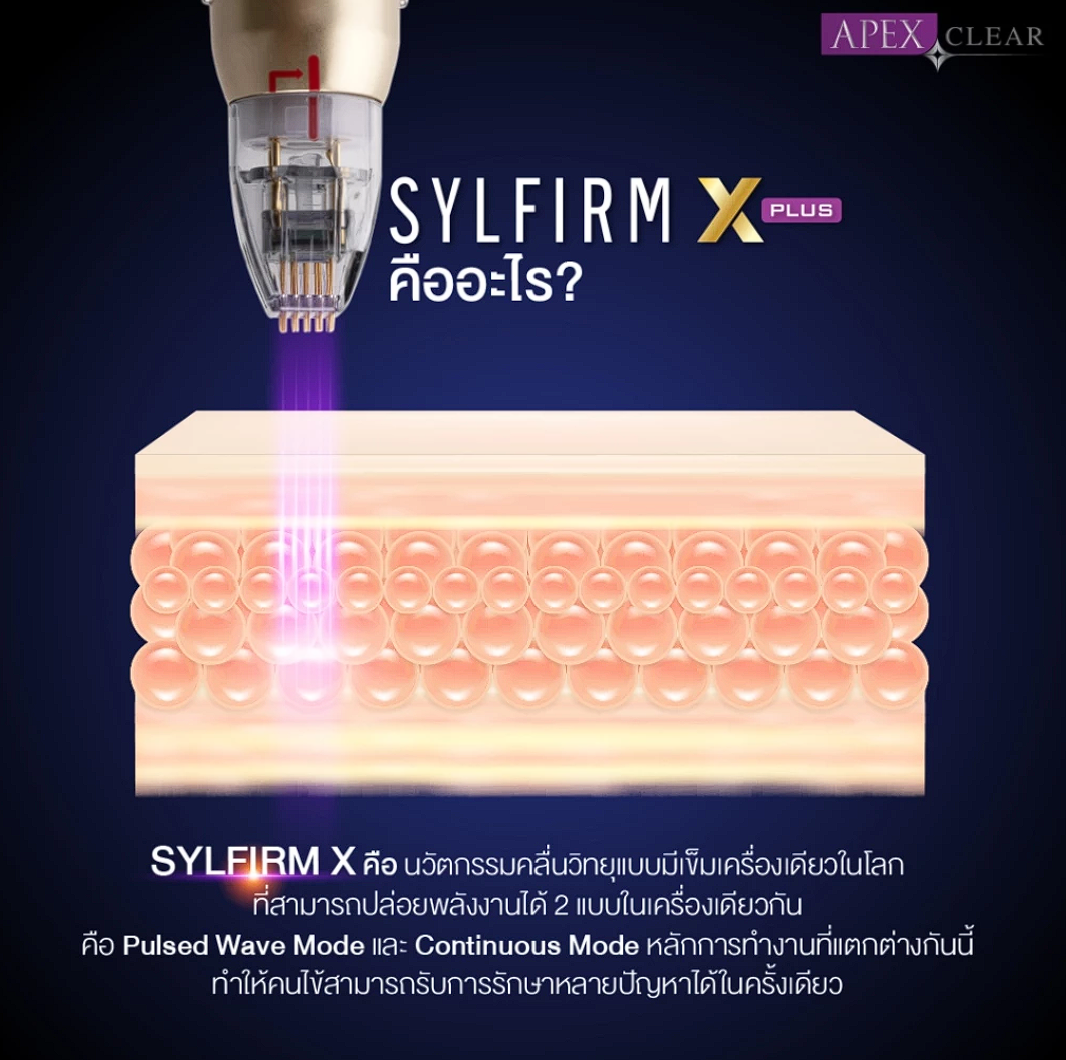 เลเซอร์เคลียร์ฝ้า 0.3 มิล ด้วย Sylfirm x Plus 2