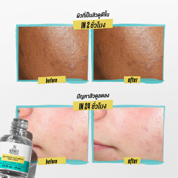 Blemish-Clearing Solution 3