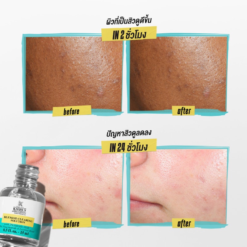 Blemish-Clearing Solution 3