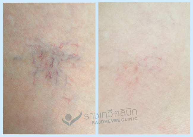 เลเซอร์หน้าใส Nd:YAG Laser 2