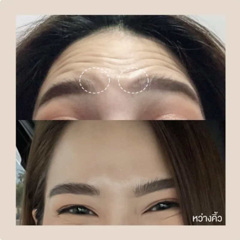 Botox (Aestox) โบท็อกซ์ ริ้วรอย 2