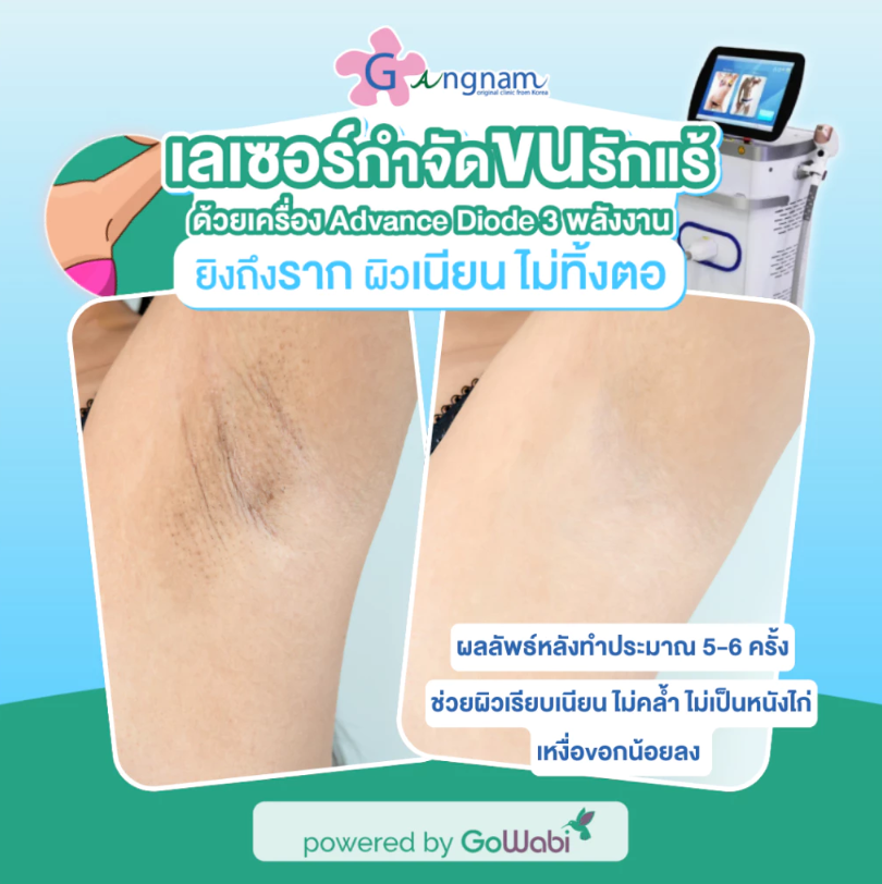โปรแกรมเลเซอร์กำจัดขน Advance Diode 3 พลังงาน บริเวณรักแร้ 12 ครั้ง 2