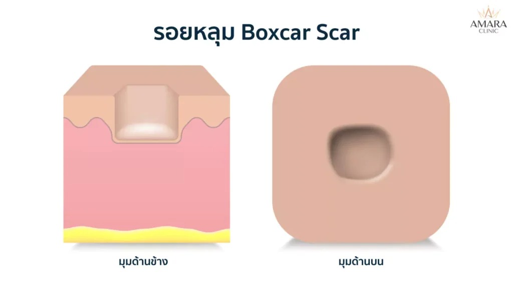 โปรแกรมรักษาสิวที่หลัง 3