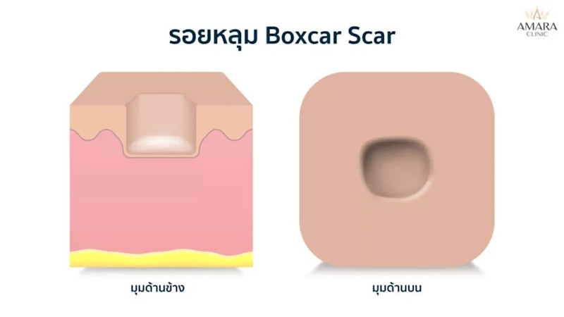 โปรแกรมรักษาสิวที่หลัง 3