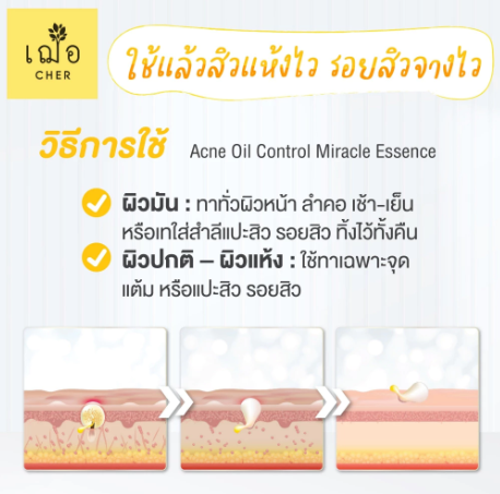 Acne Oil Control Miracle Essence Oil Free 3