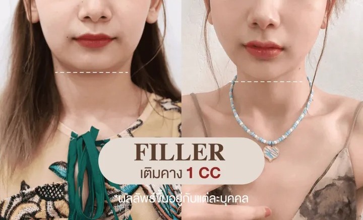 ฟิลเลอร์สวีเดน 2