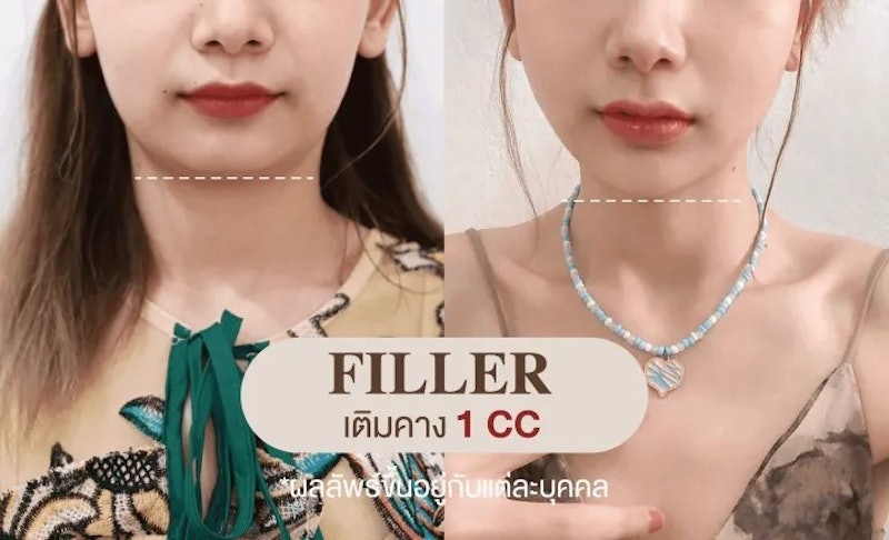 ฟิลเลอร์สวีเดน 2