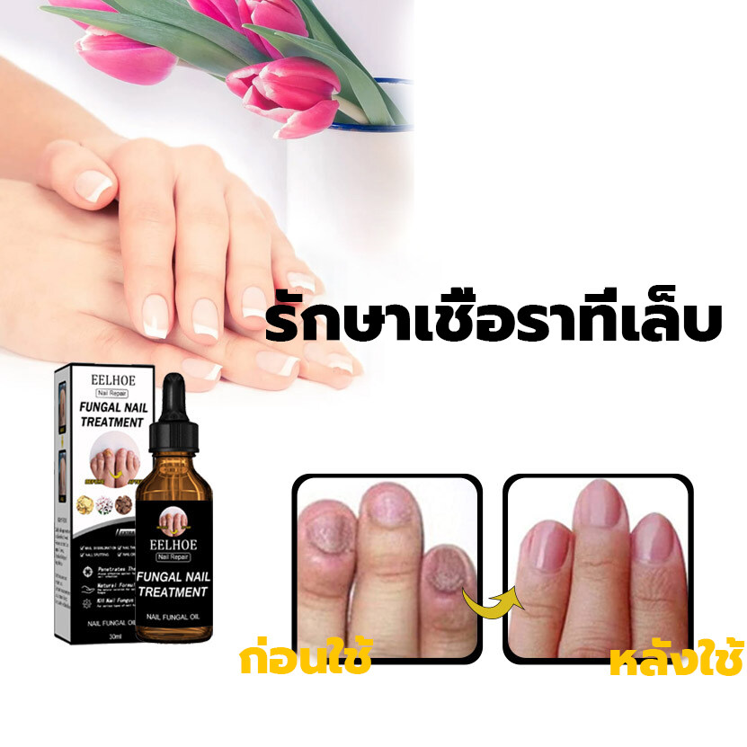 Fungal Nail Treatment 3