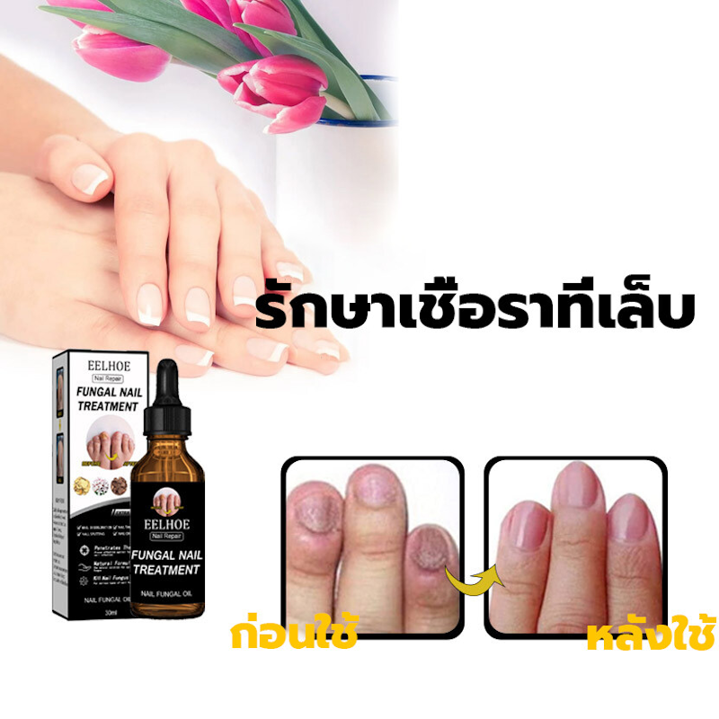 Fungal Nail Treatment 3