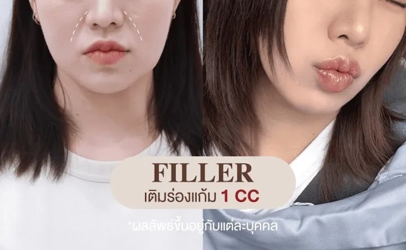 ฟิลเลอร์สวีเดน 3