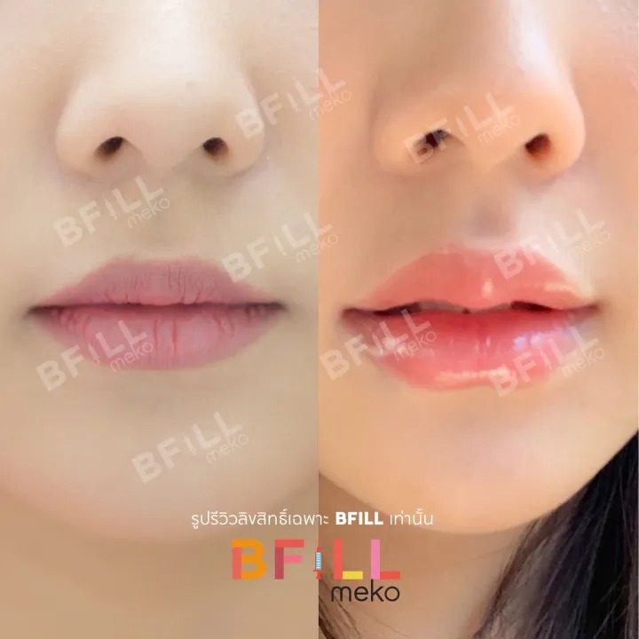 Filler Korea Juvederm Voluma 3