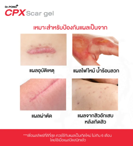 CPX Scar gel 2