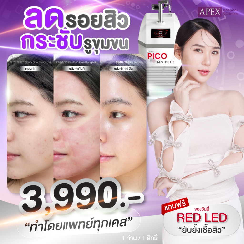 Pico Laser 2