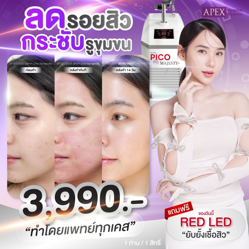 Pico Laser 2