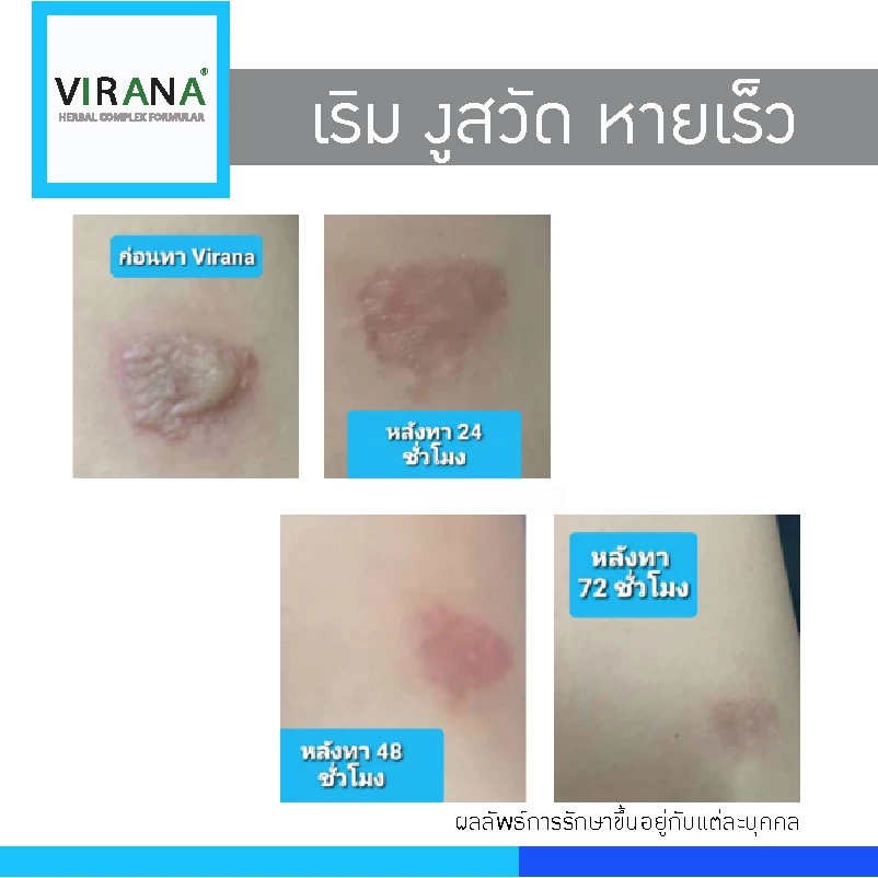 VIRANA ยาทาแก้เริม 3