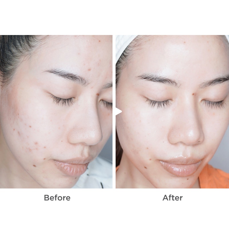 สกินแคร์ในวัตสัน V Acne Clear Booster 2