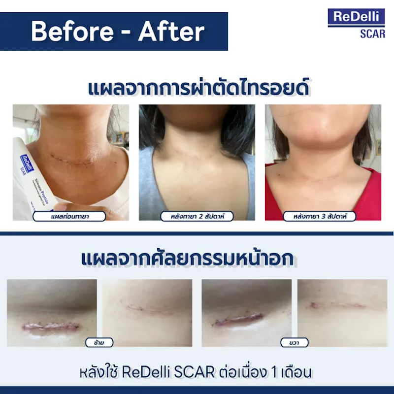 เจลดูแลป้องกันแผลเป็น SCAR Silicone - Peptide 3