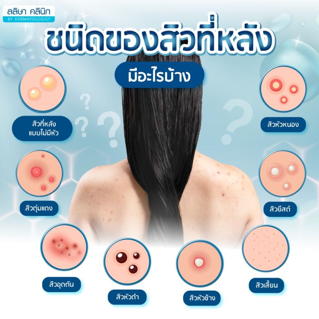 โปรแกรมรักษาสิวที่หลัง 3
