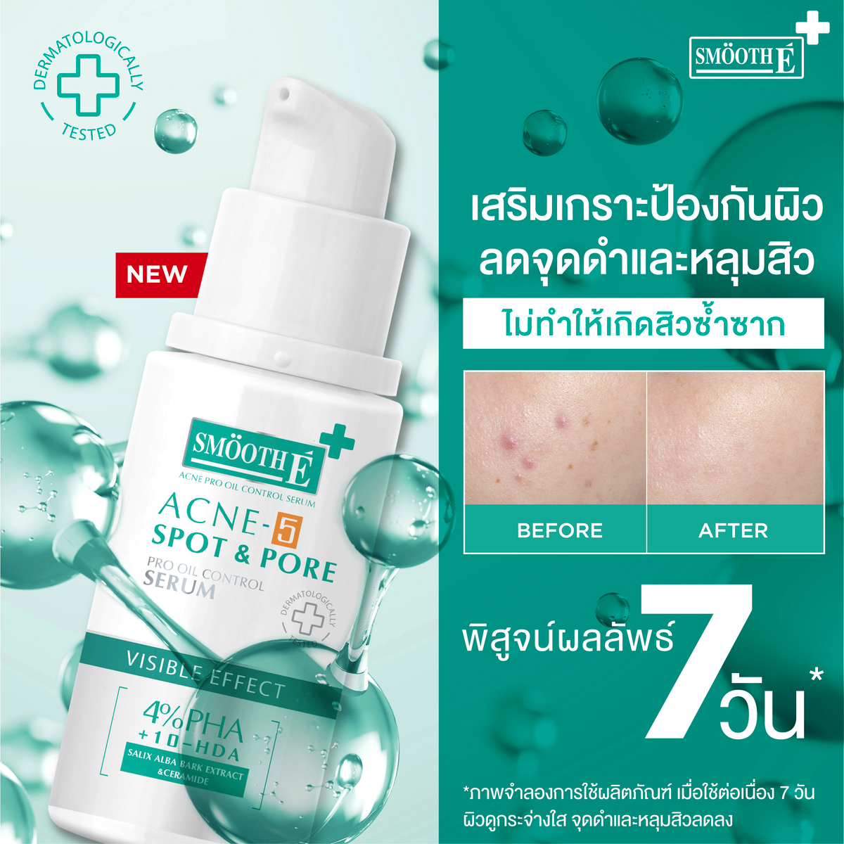 Acne 5 Spot Pore Serum 3