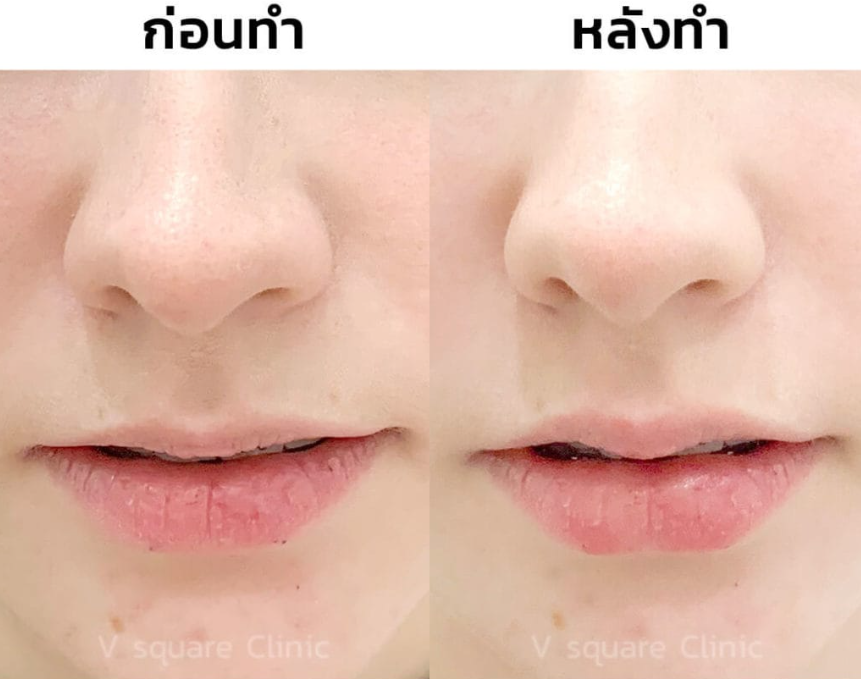 โปรแกรมฉีดฟิลเลอร์ปาก 3