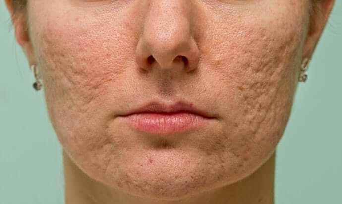 สูตรที่มีส่วนผสมของ Niacinamide และ Zinc จะช่วยควบคุมความมันส่วนเกินและลดการอุดตันได้